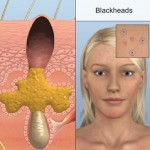 Nguyên nhân gây mụn đầu đen và giải pháp trị mụn đầu đen tận gốc