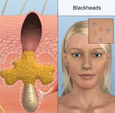 Nguyên nhân gây mụn đầu đen và giải pháp trị mụn tận gốc 3