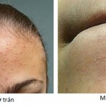Phương pháp trị mụn cám hiệu quả cho da đẹp không tì vết