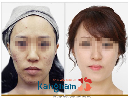 quy trình điều trị mụn bằng công nghệ nano skin 10