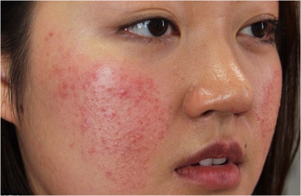 Da mặt Hương Trúc sạch tới 70% mụn chỉ sau 1 lần điều trị