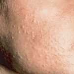 5 cách trị mụn li ti, da mặt sần sùi nhiều mụn cám hiệu quả sau 1 tuần lễ