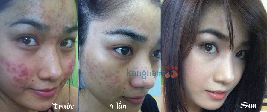 Trị mụn bằng công nghệ Nano Skin Kangnam – Da sáng mịn sau 60′