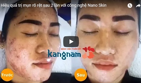 View cận cảnh trị mụn bằng Nano Skin tại Kangnam và cái kết không ngờ