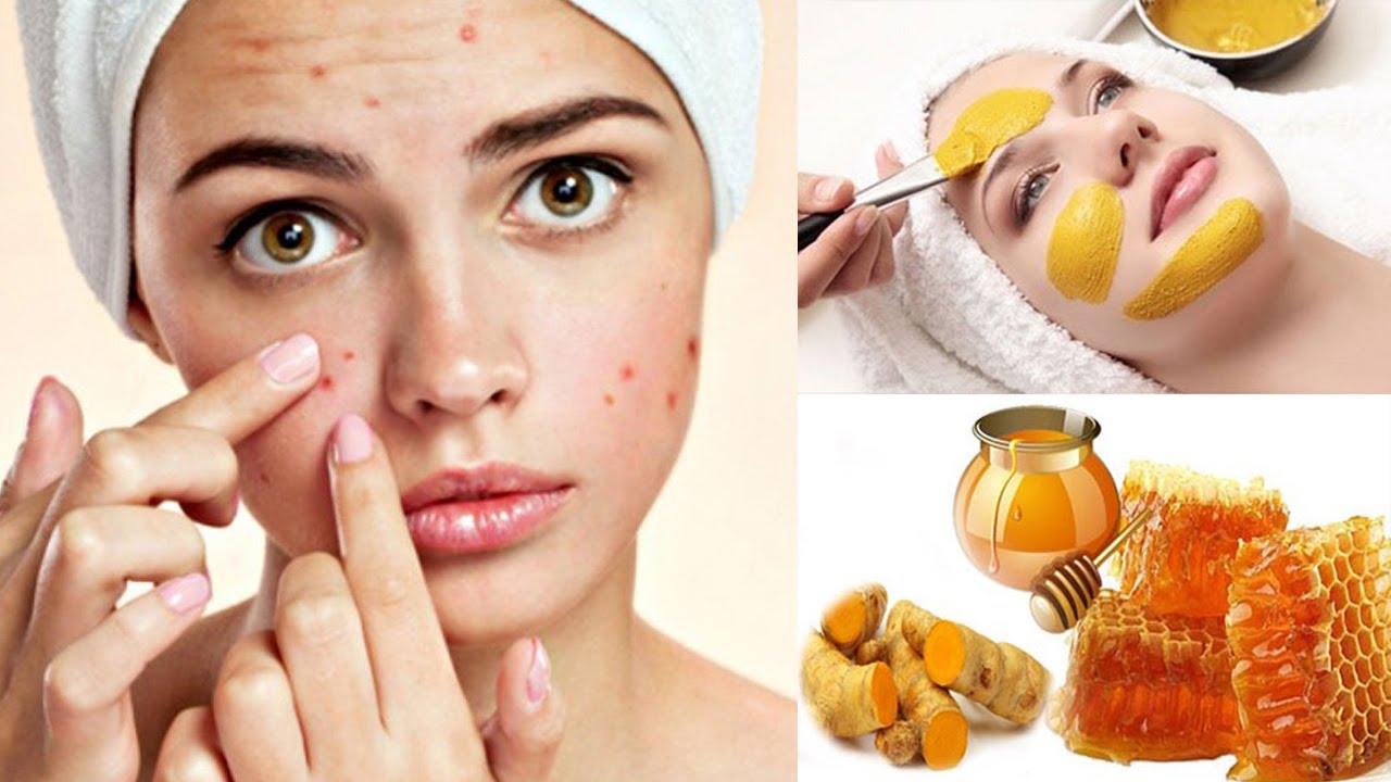 12 Cách trị mụn bằng Mật Ong tại nhà siêu Đơn giản và Hiệu quả