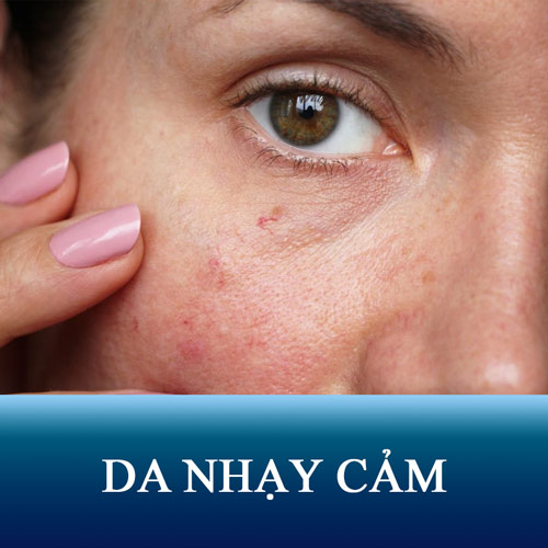 Thế nào là da nhạy cảm? 10 Biểu hiện nhận biết làn da kích ứng dễ nổi mụn!