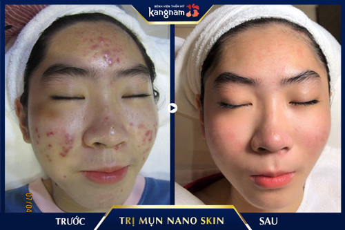 cách trị mụn ở tuổi dậy thì nam