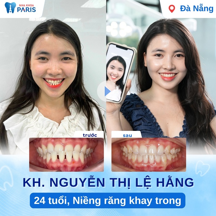 Hình ảnh khách hàng trước và sau khi niềng răng tại Paris Đà Nẵng