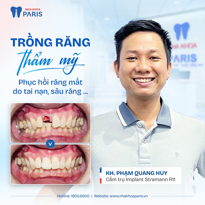 Đánh giá cao dịch vụ trồng răng tại Paris Đà Nẵng